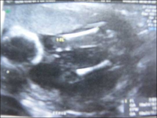 Nosso bebê - ultrasom - Schapie